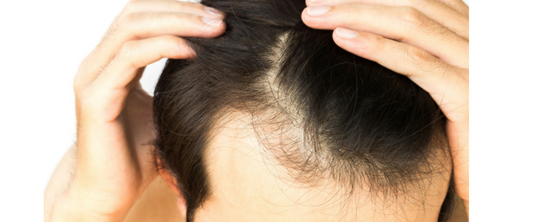 Perte des cheveux